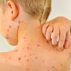 Chickenpox Vaccine: What You Need to Know (VIS ...