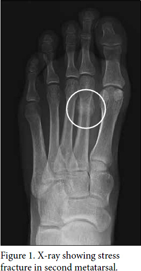 +fracture+tibia+bone+scan