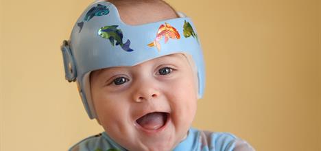 Baby Helmet Therapy: Parent FAQs