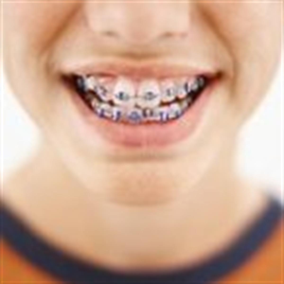 Free Dental Braces? Can My Child Get Them? - Ridgway Dental