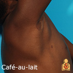 Cafe-au-lait - HealthyChildren.org