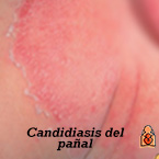 roto Salvación Terrible Tipos comunes de dermatitis del pañal y tratamientos - HealthyChildren.org