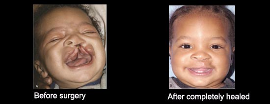 Child before cleft surgery and once completely healed