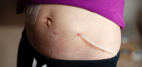 A close-up of a person's abdomen showing a small tube and healing scars. The person is wearing a purple top and black pants.
