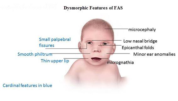 Symptoms of fetal alcohol syndrome