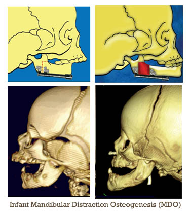 Mandibular Process Mandibular Process