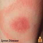 Lyme Disease - Image - HealthyChildren.org