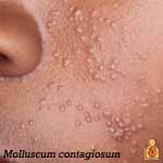 Molluscum contagiosum - Image - HealthyChildren.org