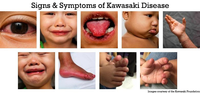 Generel solsikke trække sig tilbage Kawasaki Disease in Infants & Young Children - HealthyChildren.org