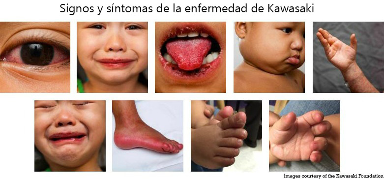 https://www.healthychildren.org/SiteCollectionImagesArticleImages/Signs_Symptoms_Kawasaki_Disease_es.jpg