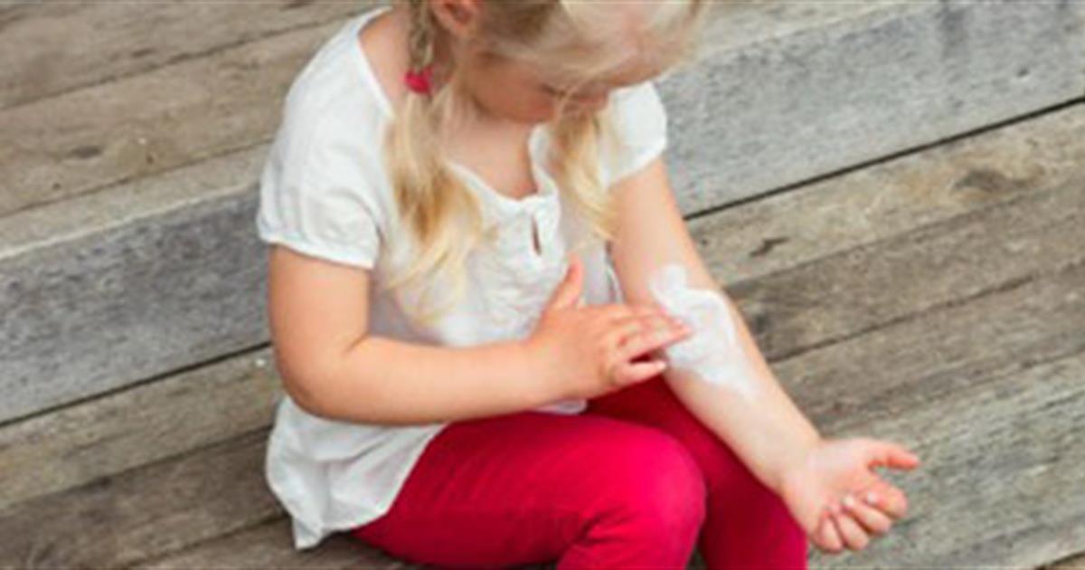 Eczema In Babies And Children Healthychildren Org