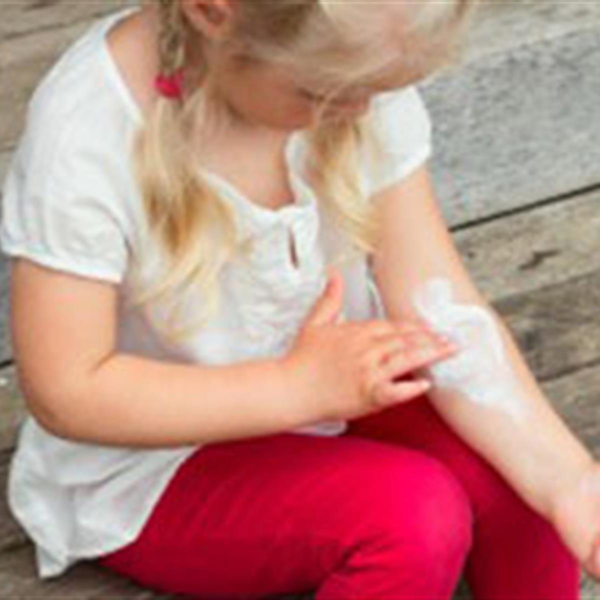 Eczema in Babies and Children - HealthyChildren.org