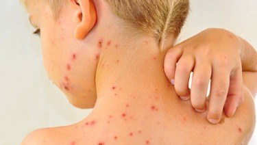 Chickenpox Vaccine: What You Need to Know (VIS ...