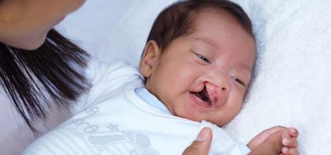 SpecialNeeds Feeder, Baby with cleft palate, Hospital use