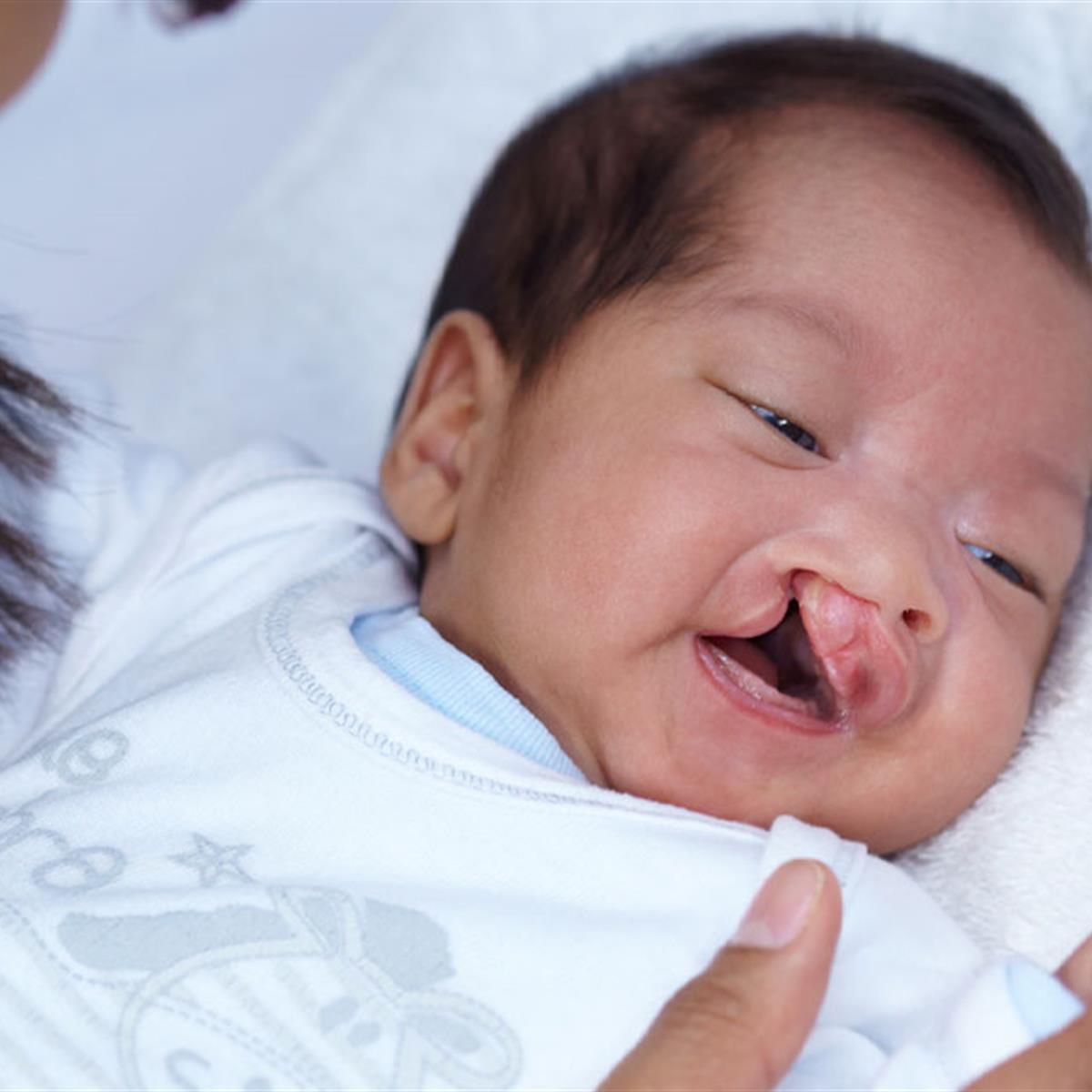 Cleft Lip And Palate