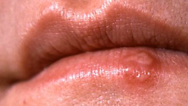 How herpes simplex is spread