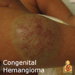 Congenital Hemangioma - HealthyChildren.org