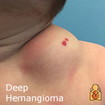 deep hemangiomas