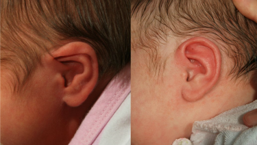 Opciones el tratamiento de orejas con formas anormales en bebés y niños - HealthyChildren.org