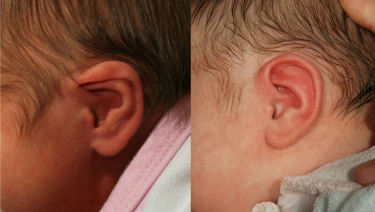 Sound Options: Treating Abnormal Ear Shape in Infants and Children 