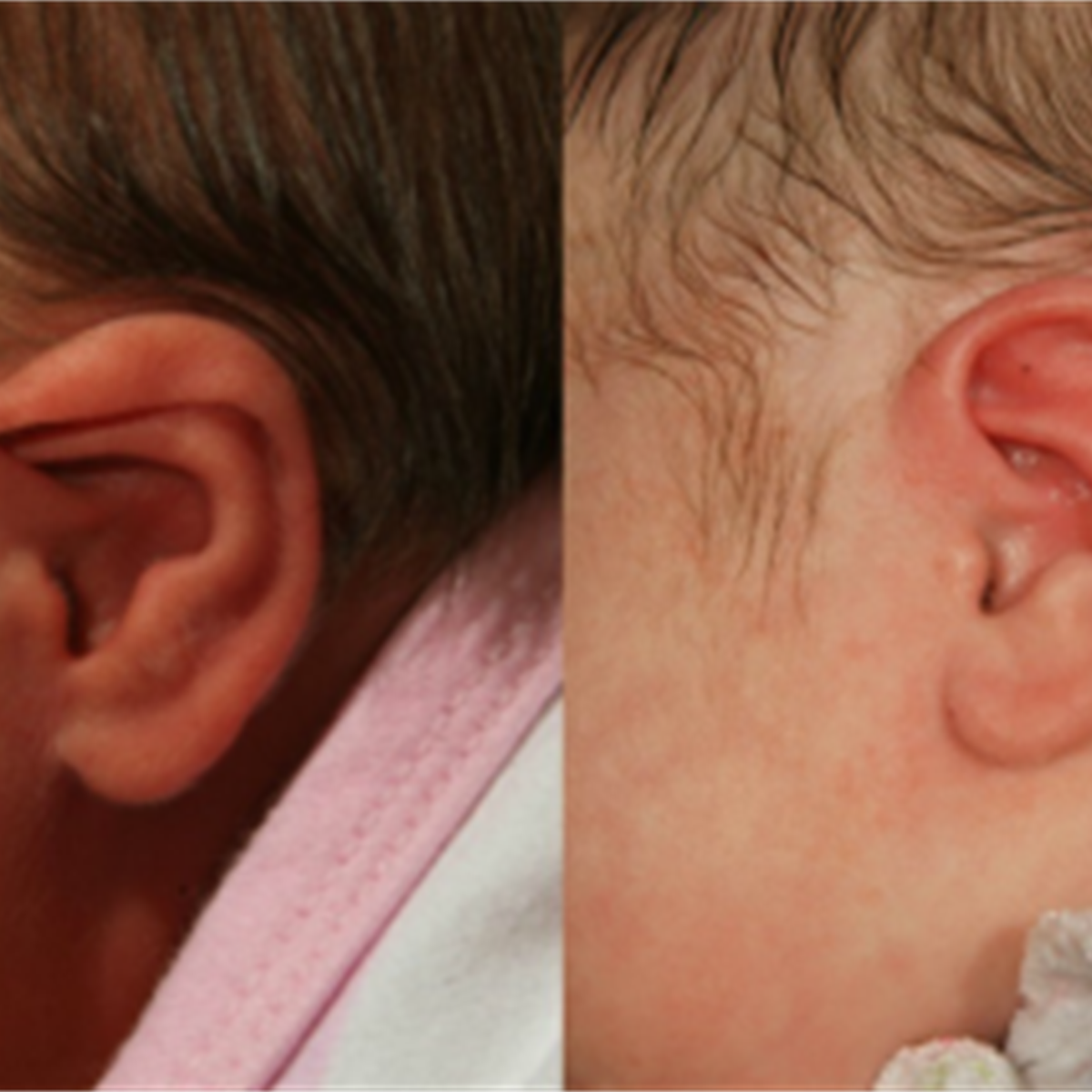 Sound Options: Treating Abnormal Ear Shape in Infants and Children -  