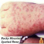 Rocky Mountain Spotted Fever - Image - HealthyChildren.org