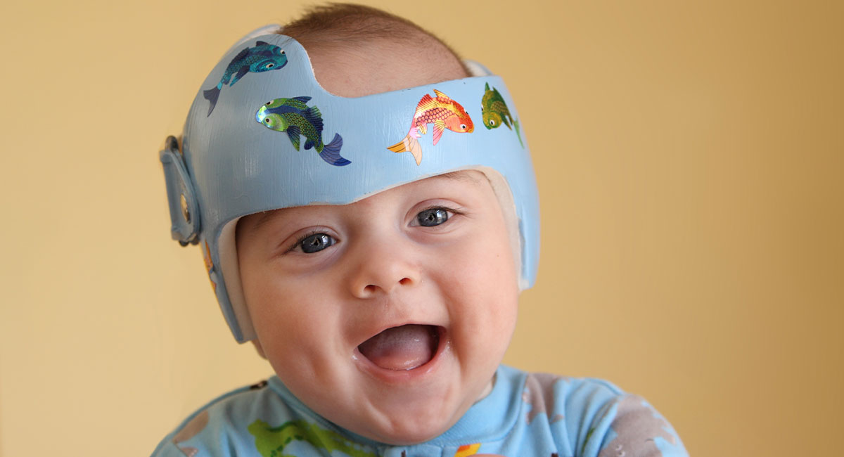 Baby Helmet Therapy: Parent FAQs 