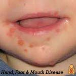 Hand, Foot & Mouth Disease - Image - HealthyChildren.org