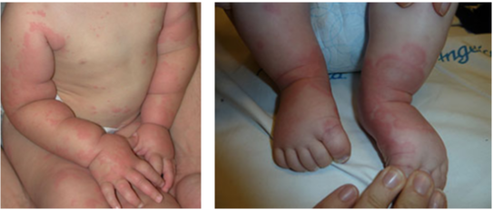 Urticarias o erupciones de la piel niños -