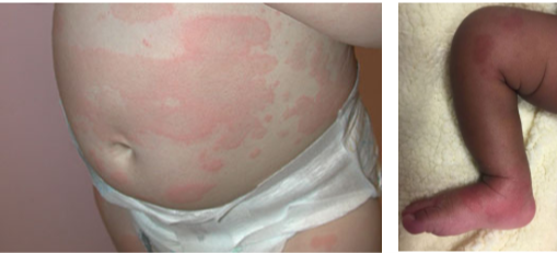 Hives Urticaria In Children Healthychildren Org