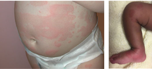 How To Treat Hives While Breastfeeding?