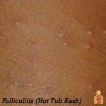 Hot Tub Rash - Image - HealthyChildren.org