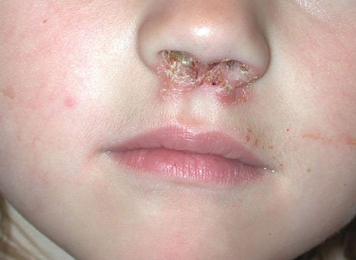 Impetigo Baby Face