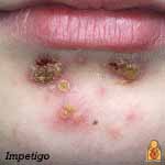 Impetigo - Image - HealthyChildren.org