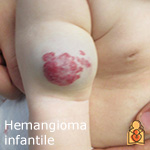 Hemangioma infantile