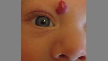 Infantile_Hemangiomas