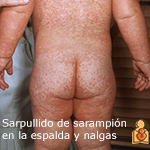 Imagen del sarpullido de sarampión en la espalda y nalgas.