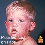 Protecting Your Baby from a Measles Outbreak FAQs