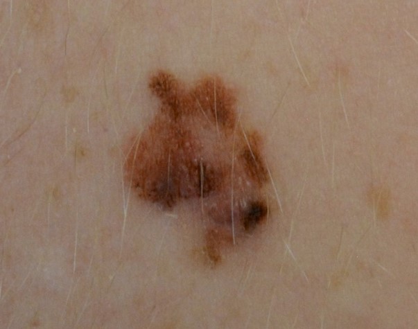 Early detection of melanoma is important, since this type of skin cancer can quickly spread to anywhere in the body. It can even develop on sun-protected skin.
