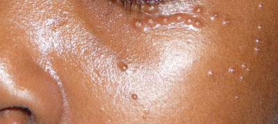 Molluscum causes small, round (usually less than ¼ inch) raised bumps (also called papules) on the skin. They are usually skin-colored or pinkish with a shiny surface. They often have a small indent or dot near the center of the bump.