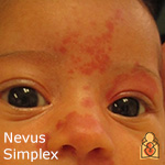 Nevus Simplex - HealthyChildren.org