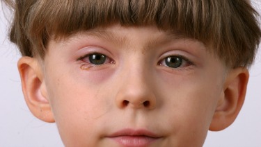 Eye Infections in Infants & Children - HealthyChildren.org