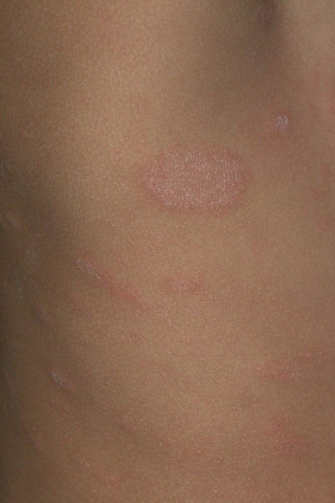 Pityriasis rosea looks like round or oval flat spots of rash on the skin. The spots may be flaky. They mostly show up on the chest, back, belly, arms, legs, and neck. It doesn't usually spread to the face.