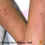 Poison Oak or Ivy - Image - HealthyChildren.org