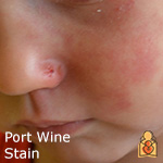 Port wine stain - HealthyChildren.org