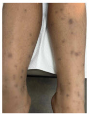 Close-up of legs showing skin with dark spots and discoloration. The background is neutral, focusing on the skin condition.