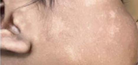Close-up of a person's cheek showing uneven skin texture and discoloration.