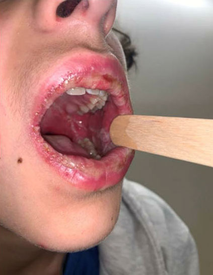 A close-up of a person's face with an open mouth, showing a wooden tongue depressor and visible oral health issues.