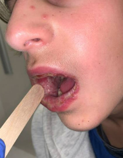 A close-up of a person's face with an open mouth, showing a wooden tongue depressor and visible oral health issues.