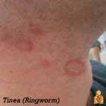 Ringworm - Image - HealthyChildren.org